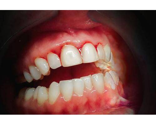 牙龈出血事小？提醒：若反复出现，或与5个因素有关，需及时就医